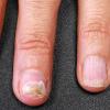 Diseases of the fingernails and their treatment
