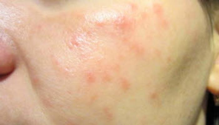 Red spots appeared on the face: what are they and how to remove them Spots on the face